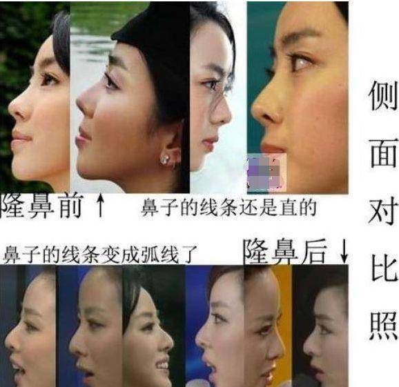 娱乐圈整容美女_混血女明星鼻子_美女整容前后对比